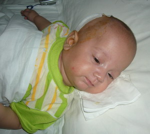 Hydrocelphalus Program Bulgaria